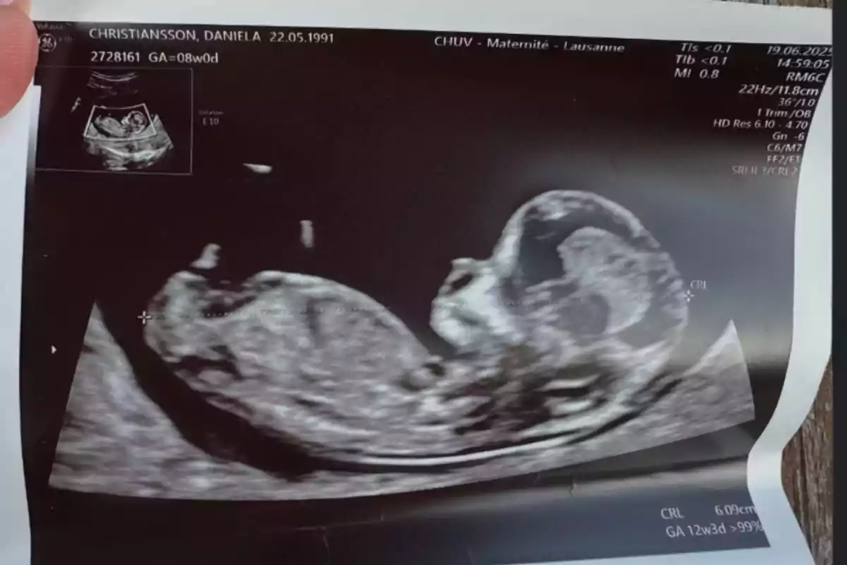 Black and white ultrasound showing the image of a developing fetus inside the uterus Black and white ultrasound showing the image of a developing fetus inside the uterus