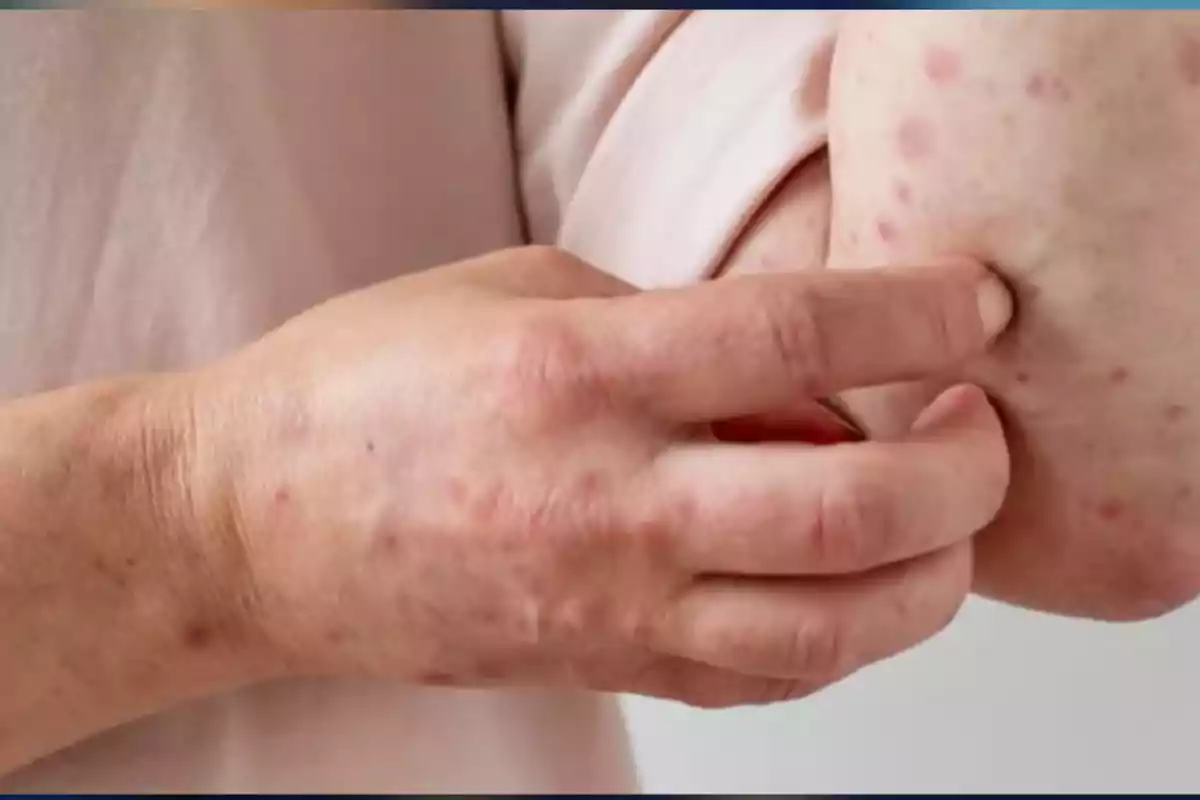 Person scratching their arm with red skin rashes