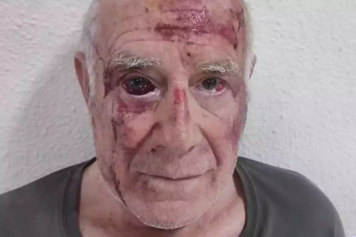 Hombre mayor con heridas visibles en el rostro y moretones en la frente y alrededor de los ojos frente a una pared blanca