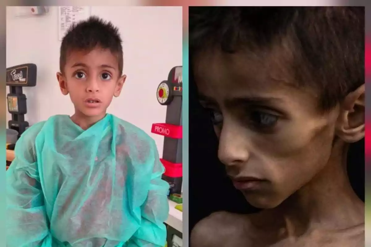 Child in a medical gown on the left and the same visibly malnourished child on the right Child in a medical gown on the left and the same visibly malnourished child on the right