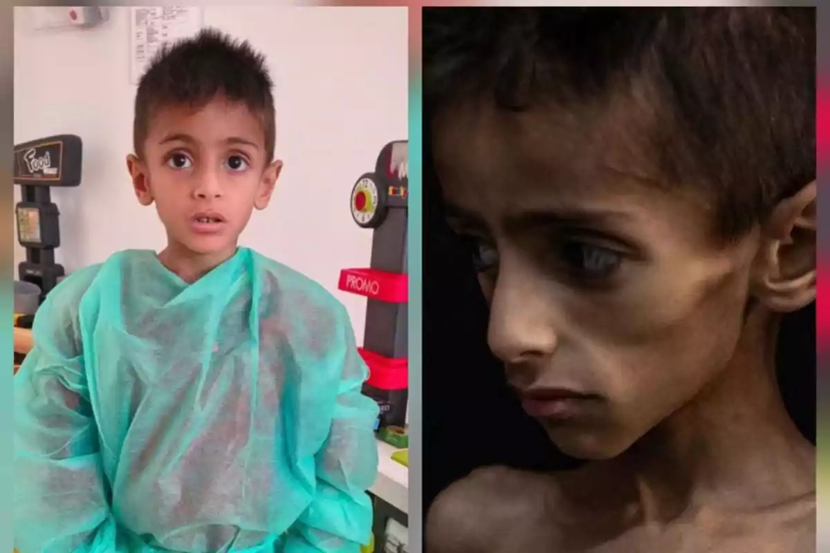 Comparación de dos niños, uno con bata médica y otro con signos visibles de desnutrición severa