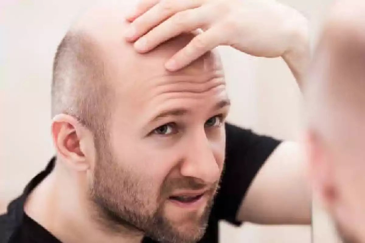 Hombre joven con barba observando su cabeza calva en el espejo mientras se toca la frente Hombre joven con barba observando su cabeza calva en el espejo mientras se toca la frente