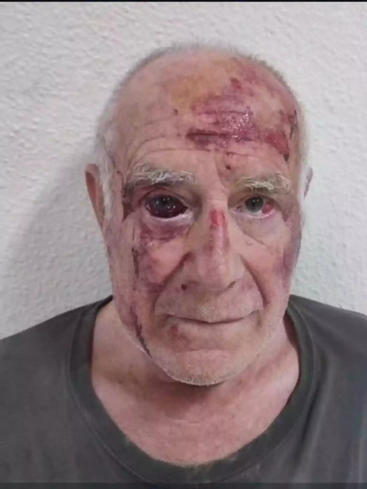 Hombre mayor con múltiples moretones y heridas en el rostro mirando a la cámara con expresión seria Hombre mayor con múltiples moretones y heridas en el rostro mirando a la cámara con expresión seria