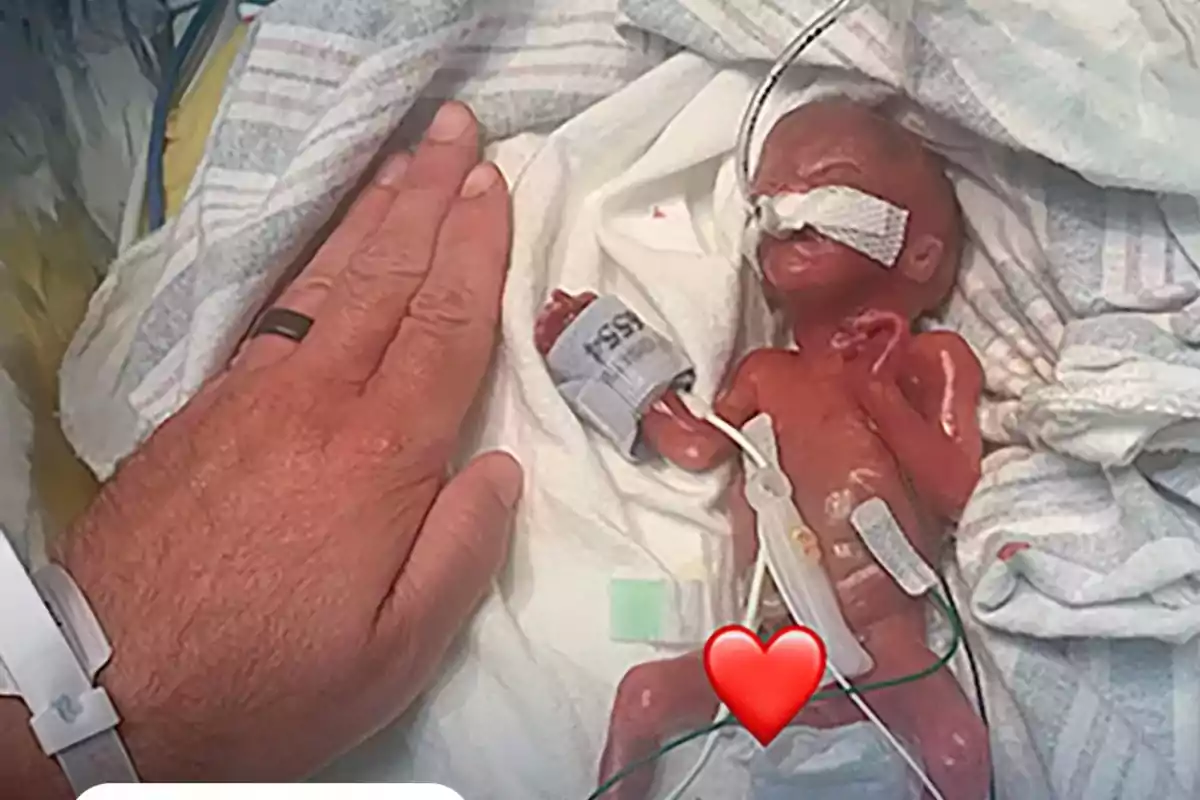 Un bebé prematuro muy pequeño está acostado en una cama de hospital junto a la mano de un adulto, rodeado de mantas y conectado a equipo médico, con un emoji de corazón cubriendo parte de su cuerpo.