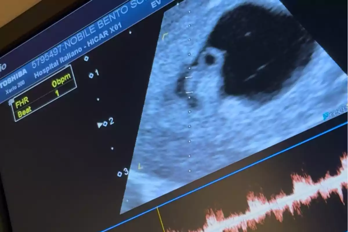 Pantalla de ecografía mostrando una imagen en blanco y negro con datos médicos y un gráfico de frecuencia cardíaca en la parte inferior Pantalla de ecografía mostrando una imagen en blanco y negro con datos médicos y un gráfico de frecuencia cardíaca en la parte inferior