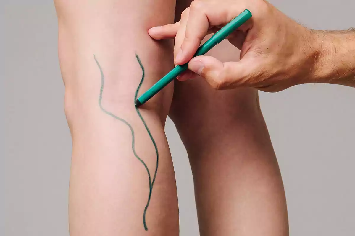 Person drawing wavy lines on a leg with a green marker Person drawing wavy lines on a leg with a green marker