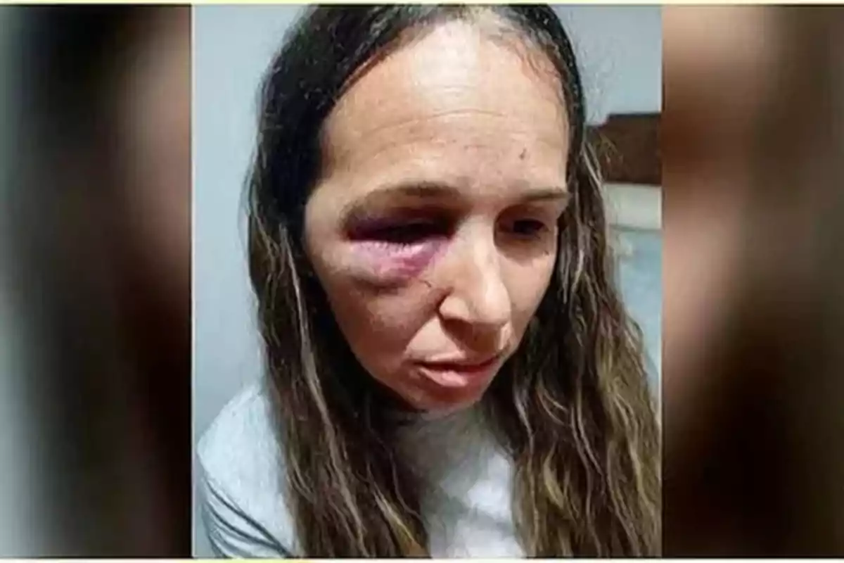 Mujer con moretón visible en el ojo izquierdo y expresión seria Mujer con moretón visible en el ojo izquierdo y expresión seria