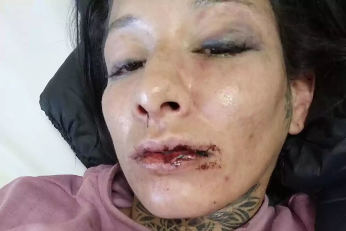 Mujer recostada con moretones en el ojo y heridas en los labios Mujer recostada con moretones en el ojo y heridas en los labios