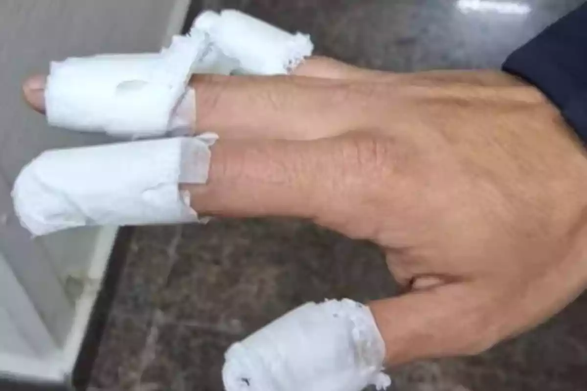 Hand with several fingers bandaged and covered with white gauze Hand with several fingers bandaged and covered with white gauze