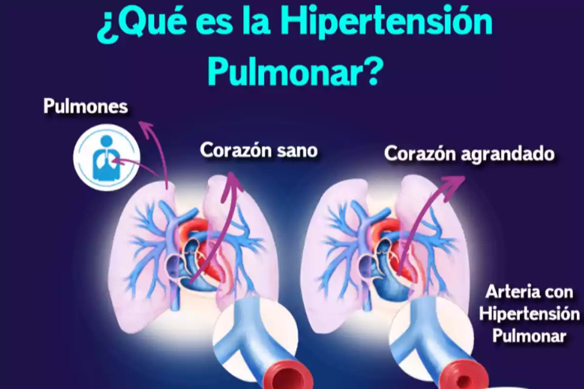 Comparación visual entre un corazón sano y un corazón agrandado por hipertensión pulmonar mostrando los pulmones y las arterias afectadas Comparación visual entre un corazón sano y un corazón agrandado por hipertensión pulmonar mostrando los pulmones y las arterias afectadas