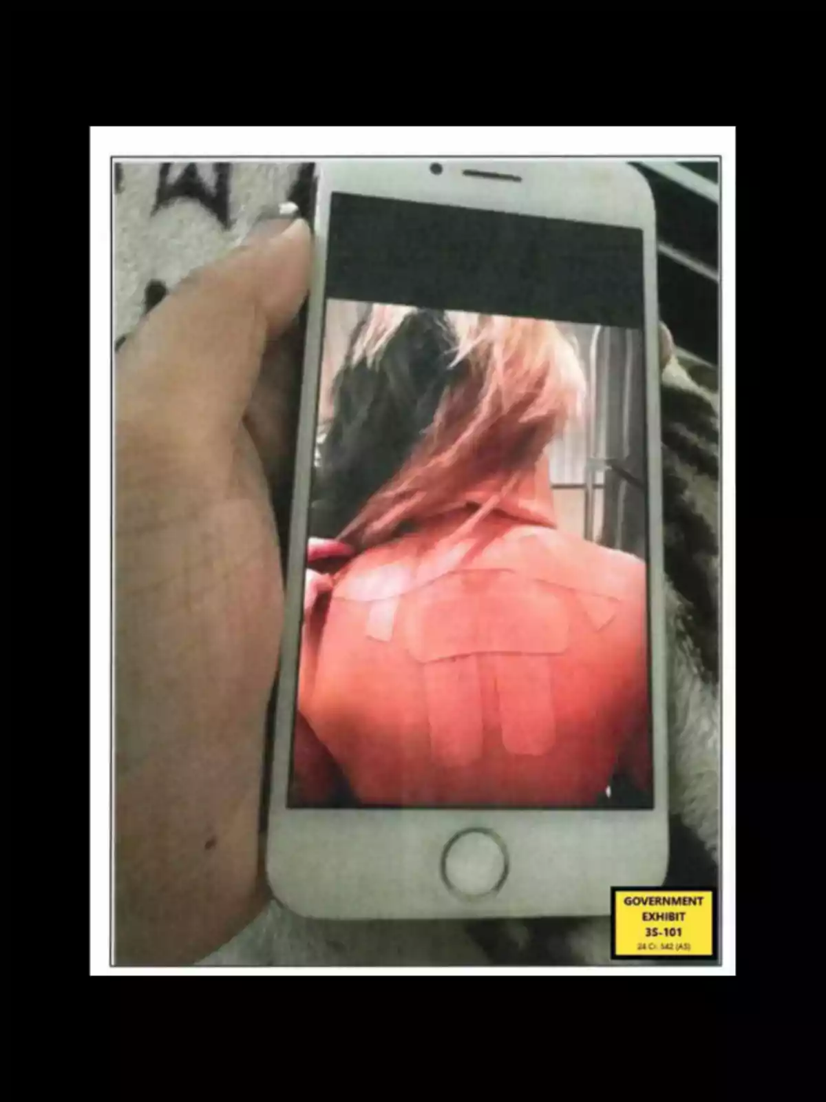 Persona sosteniendo un teléfono móvil que muestra la imagen de la espalda de alguien con marcas rojas y varios parches adhesivos Persona sosteniendo un teléfono móvil que muestra la imagen de la espalda de alguien con marcas rojas y varios parches adhesivos