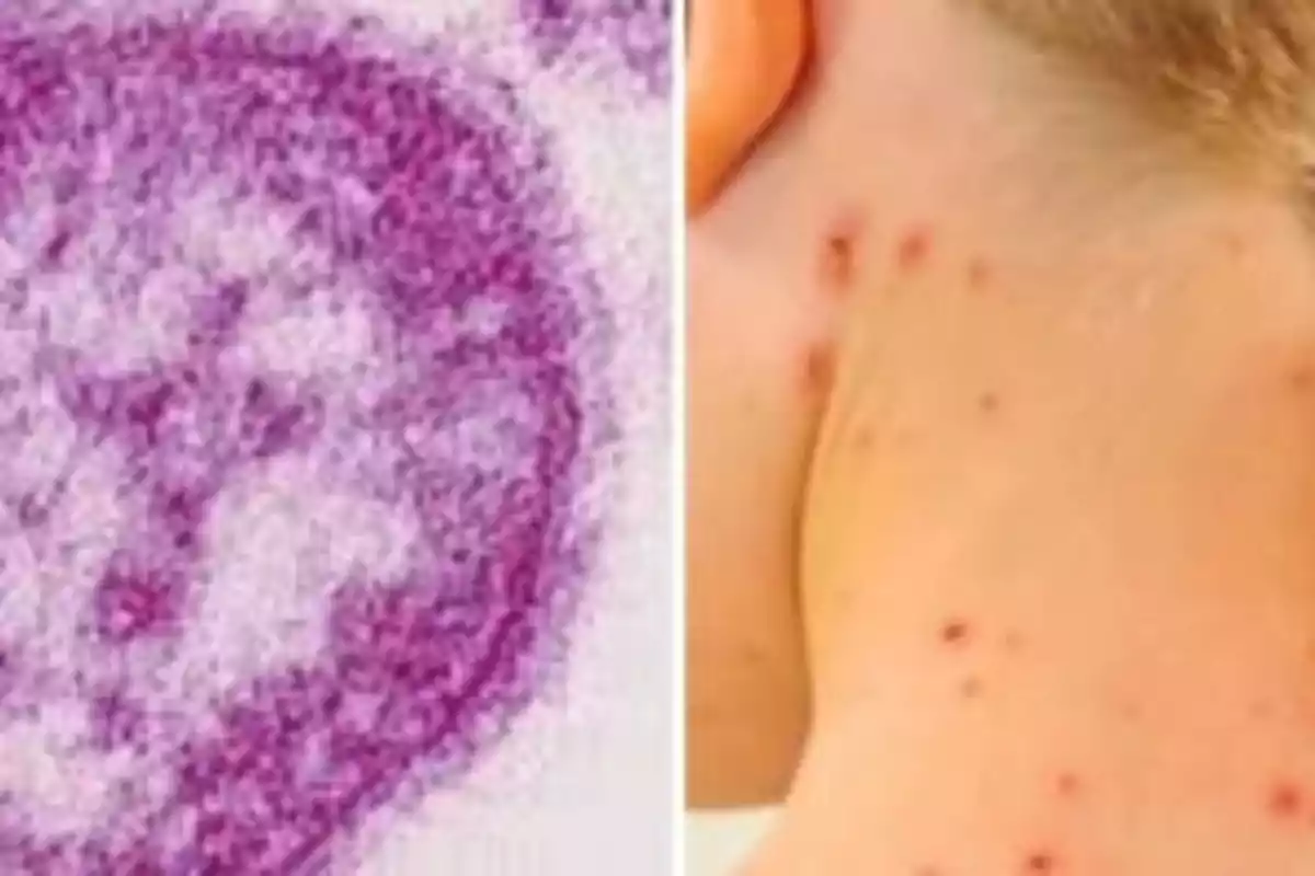 Split image showing a virus under a microscope on the left and skin with rashes on the right. Split image showing a virus under a microscope on the left and skin with rashes on the right.